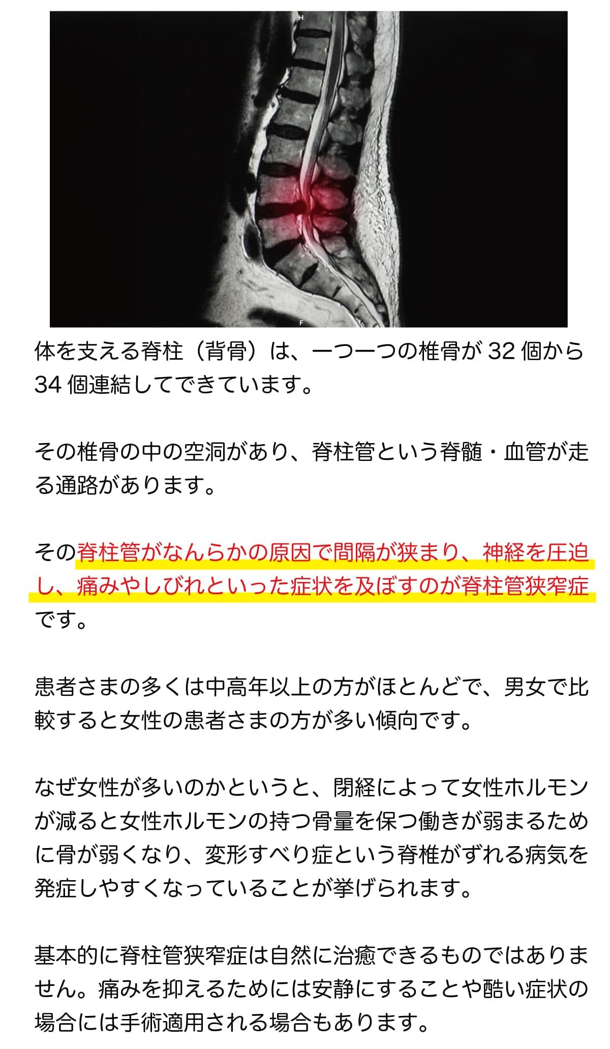 脊柱管狭窄症とは？